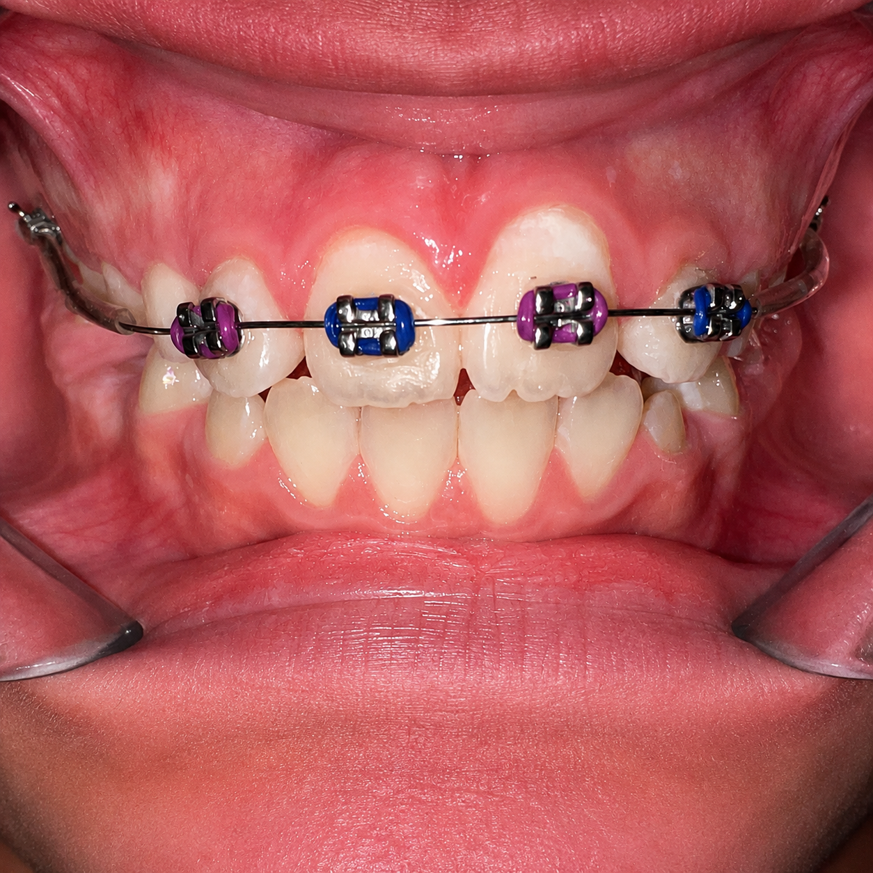 Early Orthodontic Assessment — after