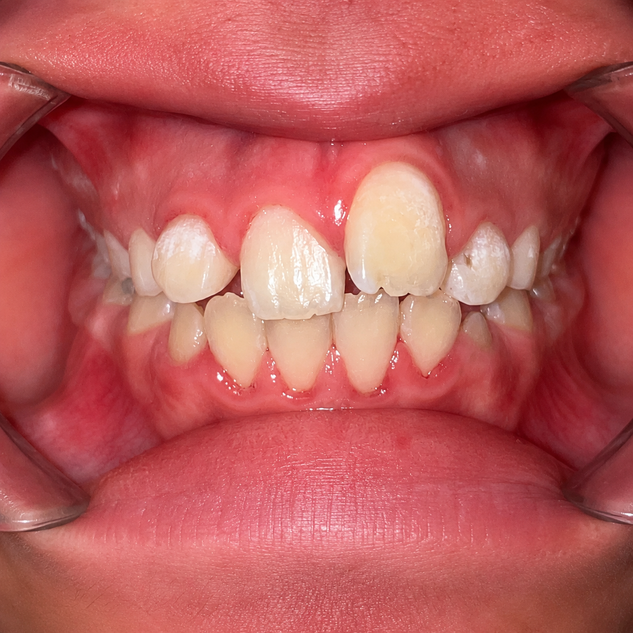 Early Orthodontic Assessment — before
