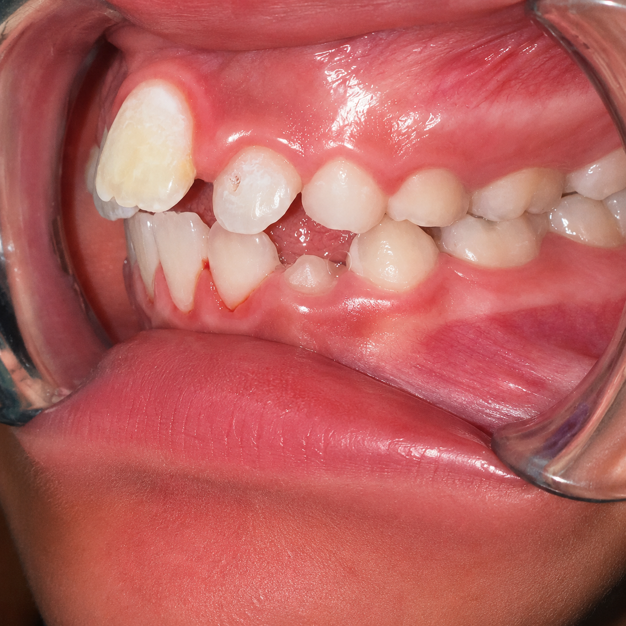 Treatment Progress Monitoring — before