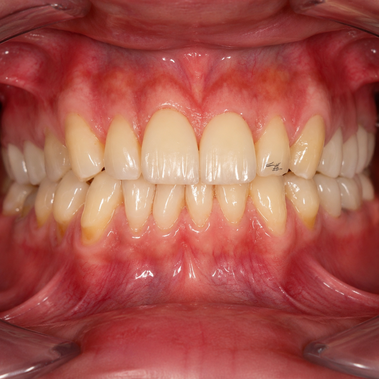 Early Orthodontic Evaluation for Children: What Parents Should Know