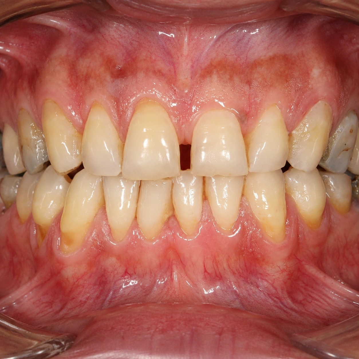 Braces vs Clear Aligners for Adults: Key Considerations